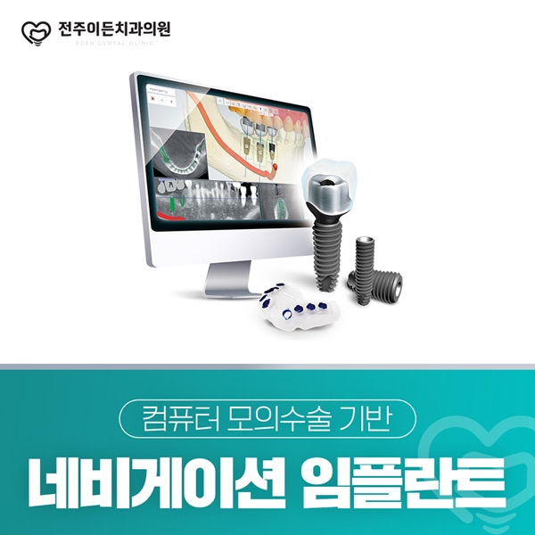 네비게이션 임플란트 컴퓨터 모의수술 기반